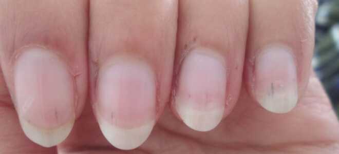 Выбор маникюра и ухода при близком расположении сосудов