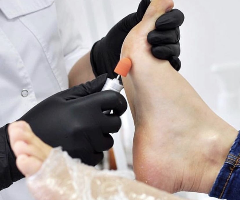 Один из этапов лечебного педикюра