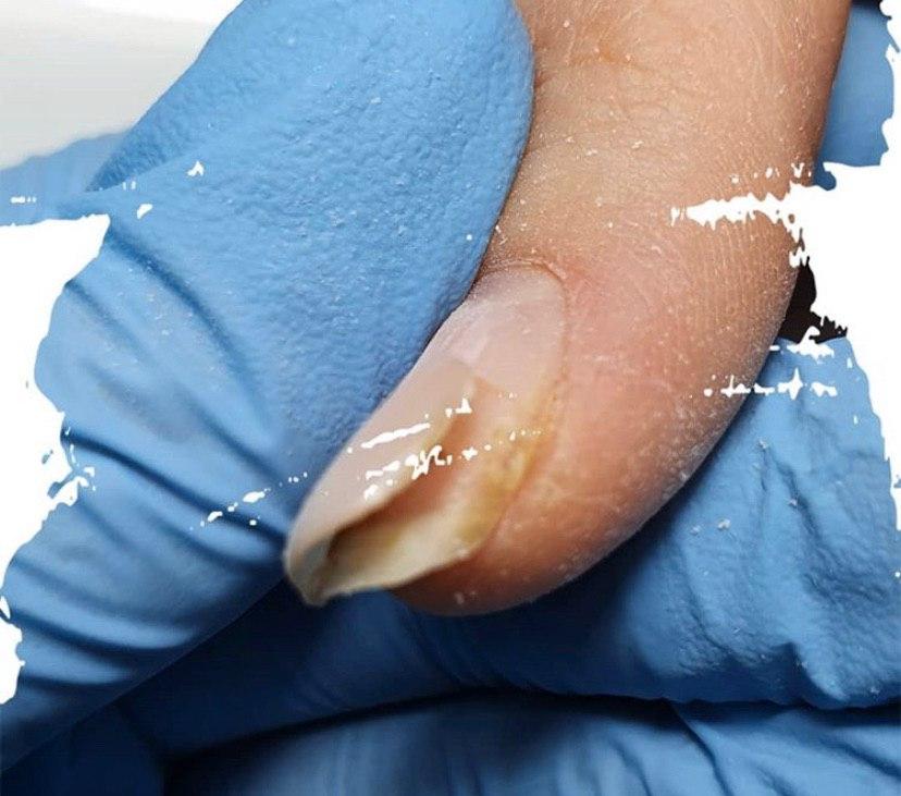 Почему отслойки на ногтях