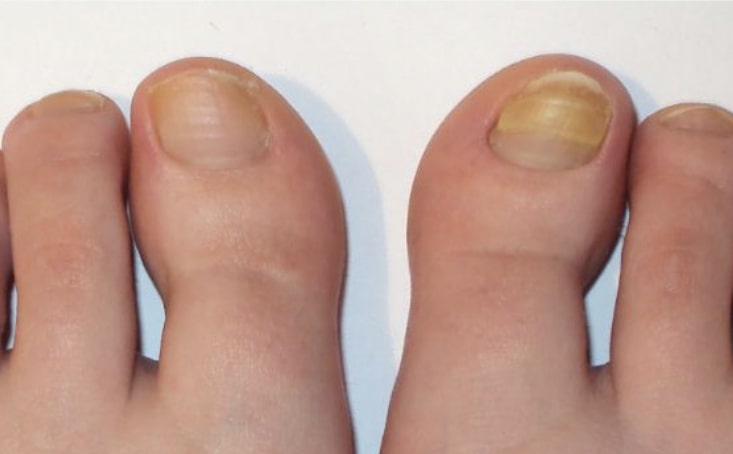 Пример грибка ногтя