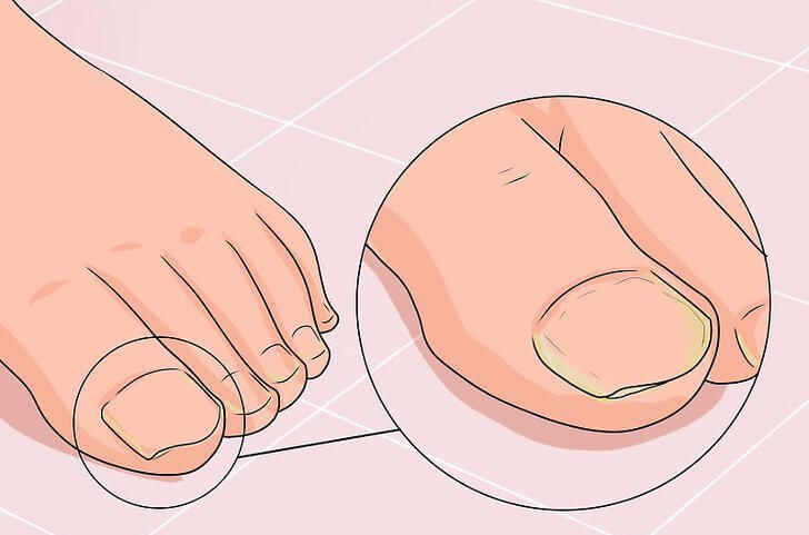 Лечение деформации ногтя медицинским педикюром