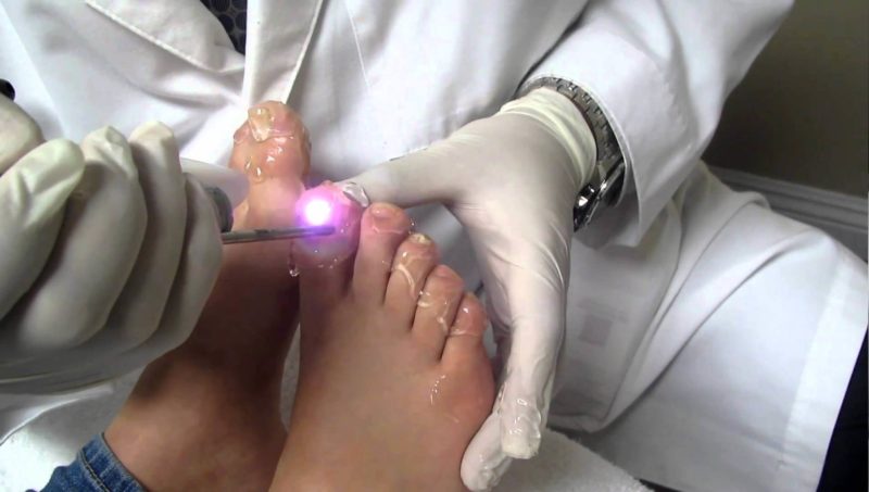 Этапы проведения лазерной процедуры