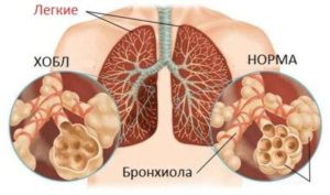 Хроническая обструктивная болезнь легких 