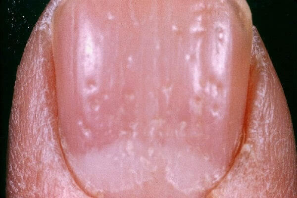 Ямки или дырочки на ногтях причины и лечение