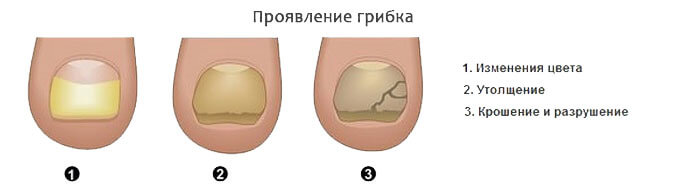 Этапы развития онихомикоза