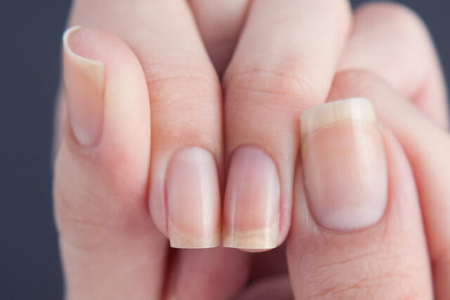 Что такое ониходистрофия