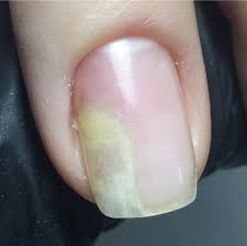 Отслоение ногтя