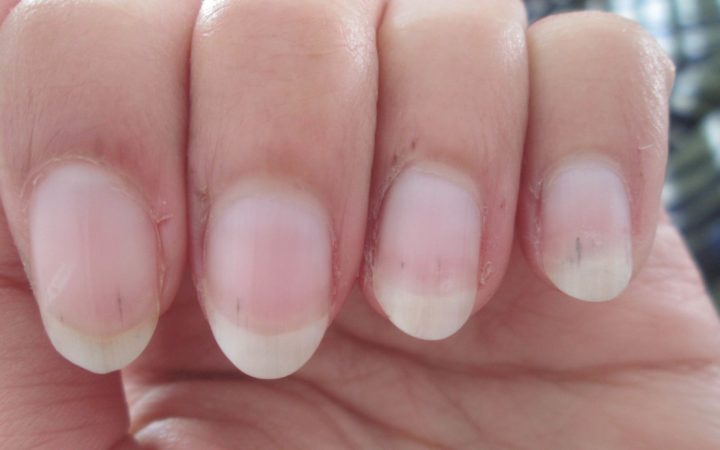 Проблемы с ногтями, близкие сосуды
