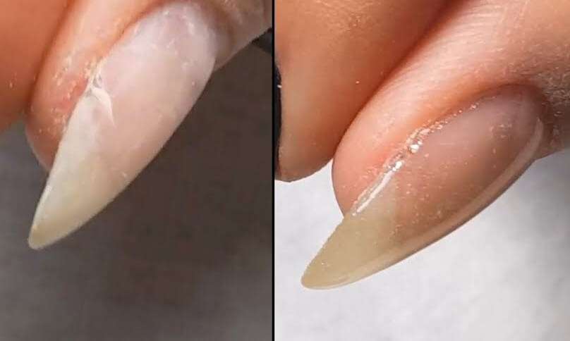 Растрескивание, трещины на ногтях как избавиться