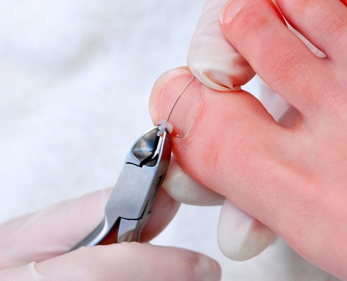 Установка скобы на ноготь