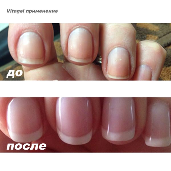 Vitagel до после - фото